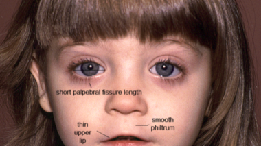 Fetal Alcohol Spectrum Disorder : It’s not all about the face!